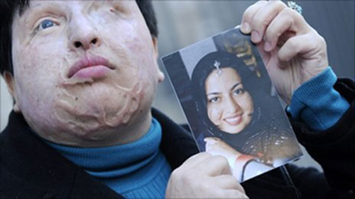 A victim of acid attack in Iran before and after she was attacked.